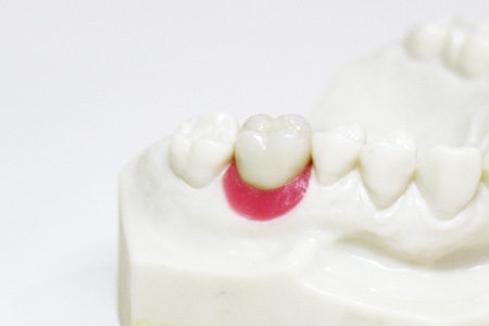 写真：審美・クラウン