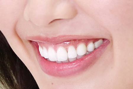 写真：ホワイトニング