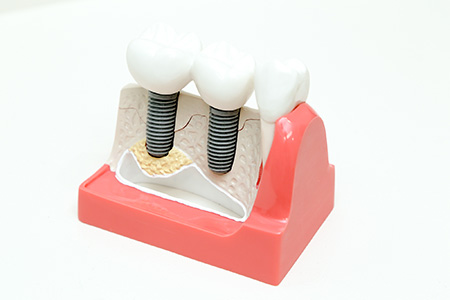 写真：インプラント